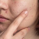 best acne treatment in bangalore​